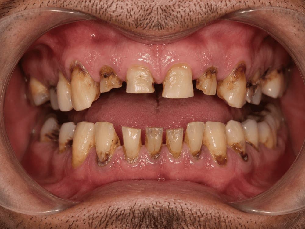 Teeth Reconstruction Before