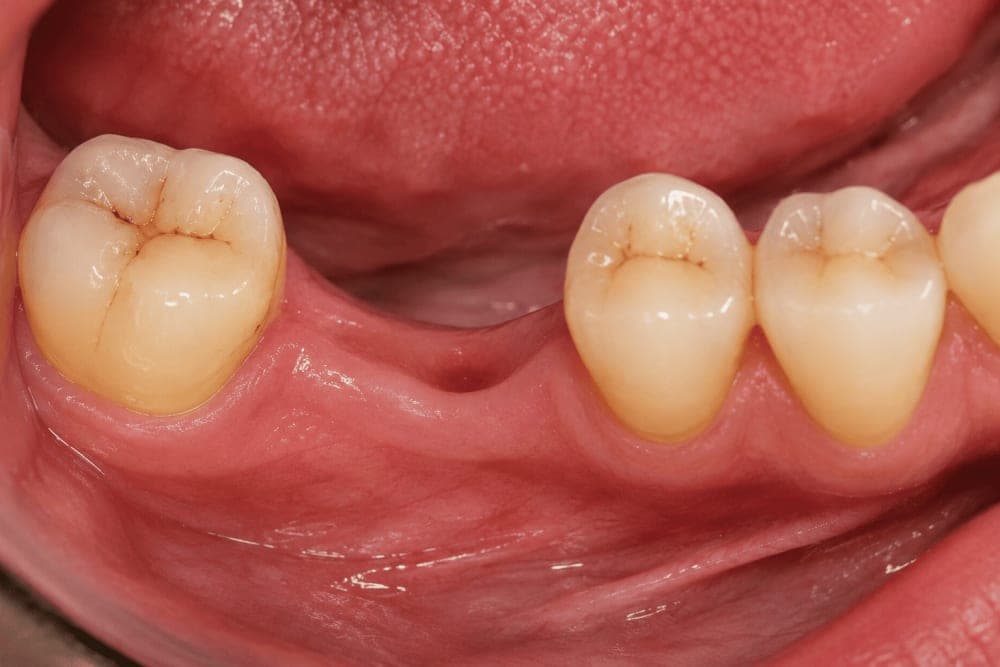 Dental Implant Restoration Before