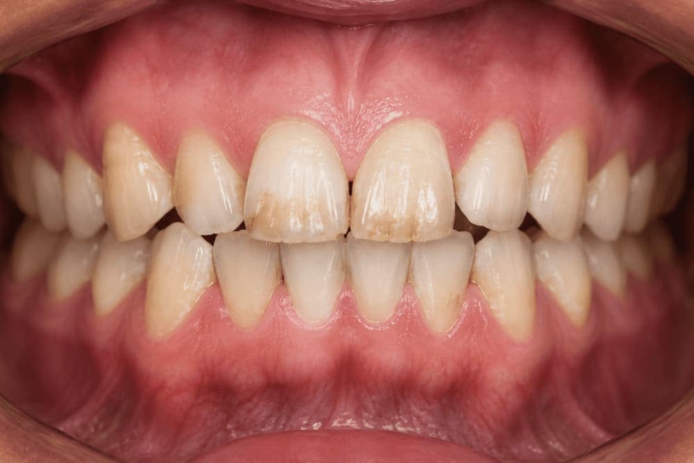 Cosmetic Smile Makeover Before
